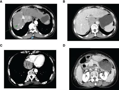 Case Report: Radiotherapy Plus Immunotherapy and Lenvatinib for the Treatment of Recurrent Hepatocellular Carcinoma With a Right Atrium and Inferior Vena Cava Tumor Thrombus